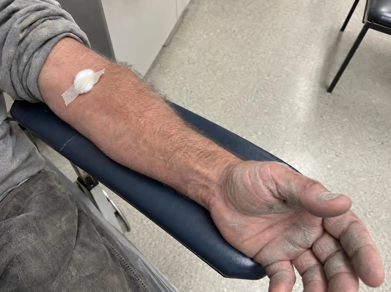 Sunburned forearm on a blue lab chair armrest, a cotton ball taped inside the elbow, the open hand grey with concrete dust